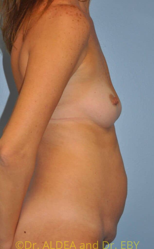 Before Image: Mommy Makeover #105 - right-side
