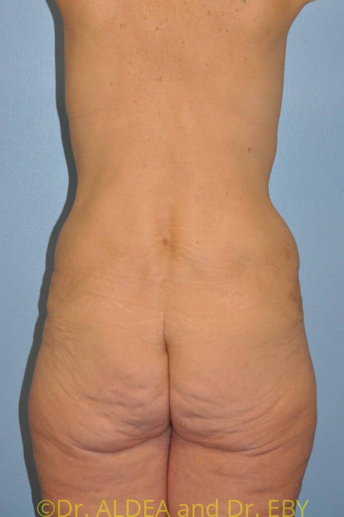 Before Image: Weight loss (MWL) Butt and Thigh Lift #778 - back