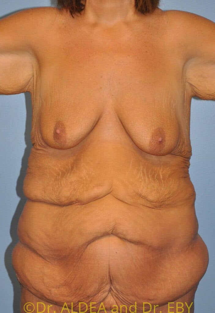 Before Image: Massive Weight Loss Tummy Tuck #297 - front