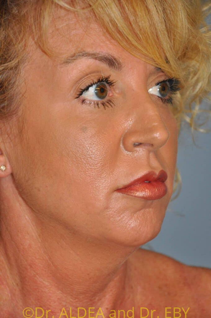Before Image: Neck Liposuction #181 - right-front-oblique