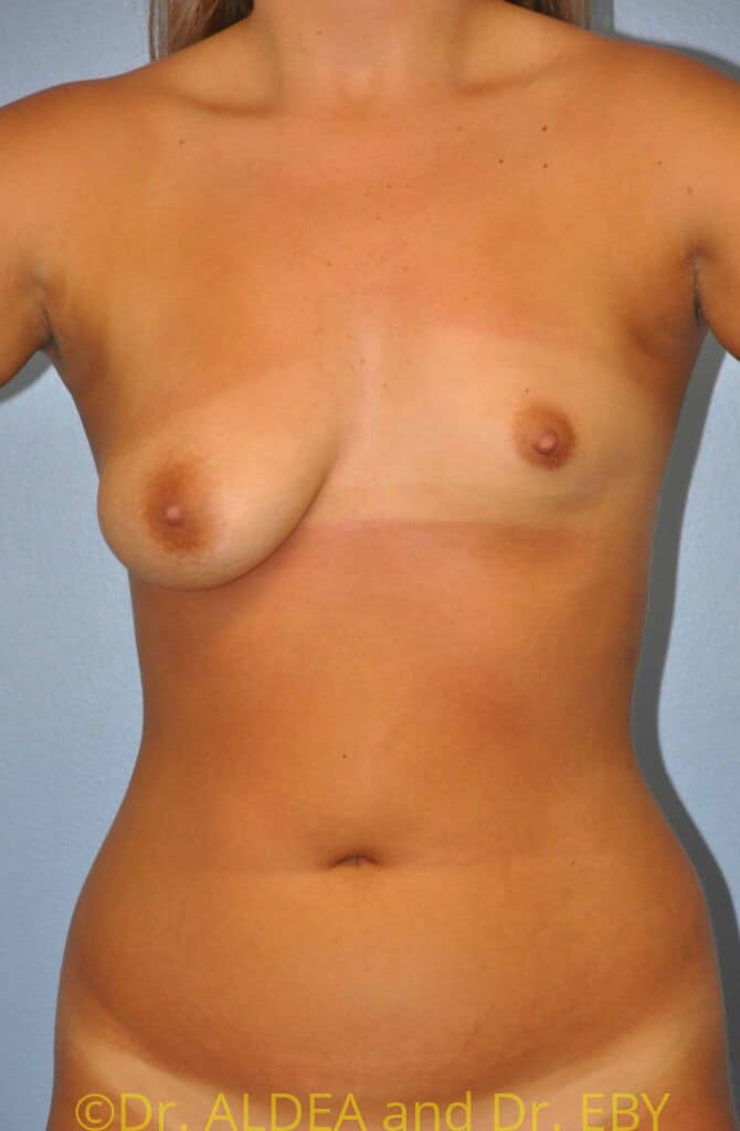Before Image: Breast Augmentation #907 - front