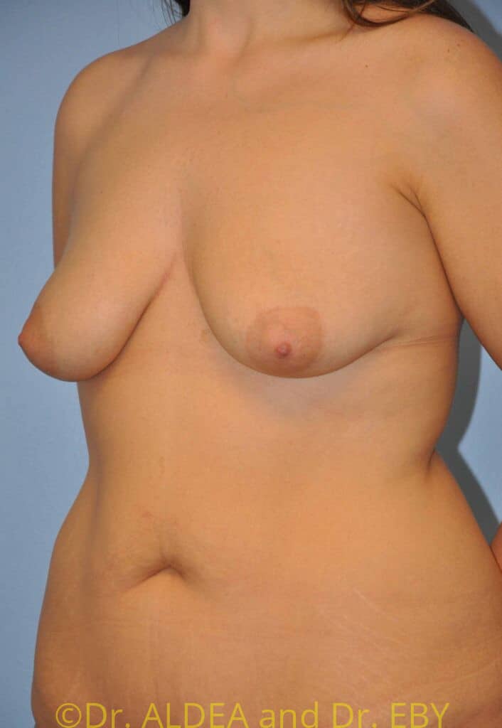 Before Image: Breast Augmentation w/ Lift #173 - left-front-oblique