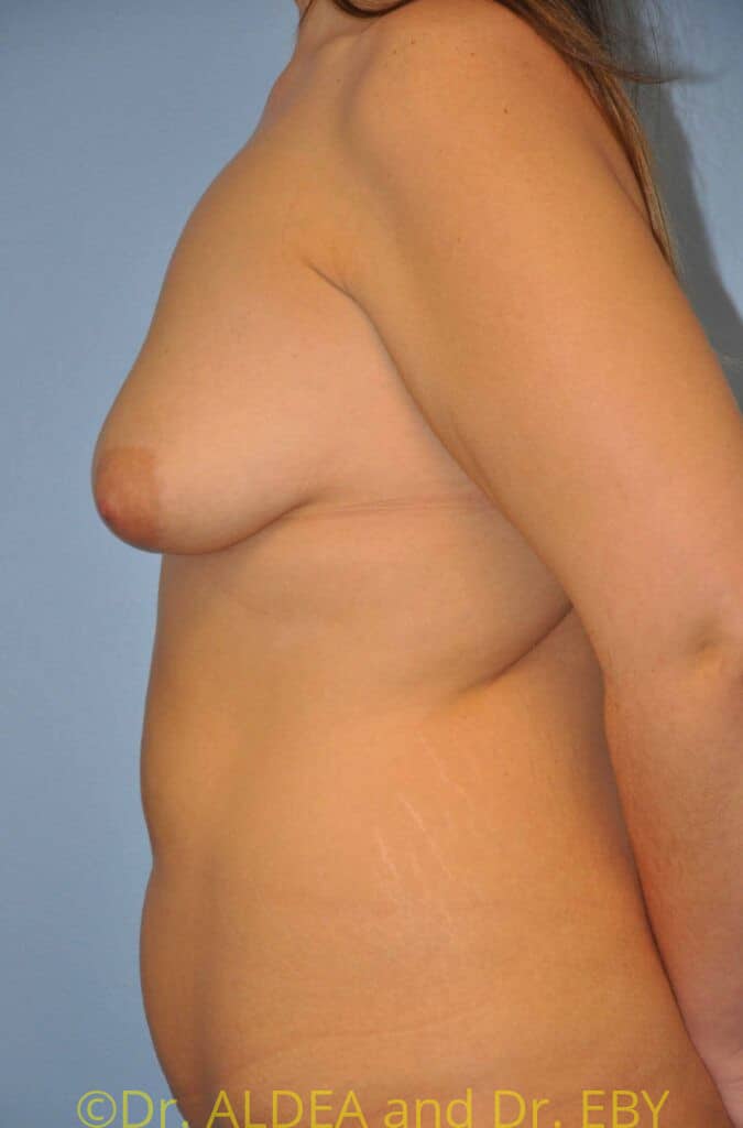 Before Image: Breast Augmentation w/ Lift #173 - left-side