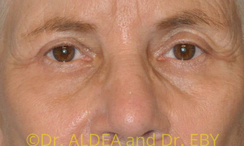 After Image: Blepharoplasty #708 - front