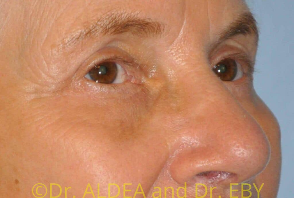 After Image: Blepharoplasty #708 - right-front-oblique