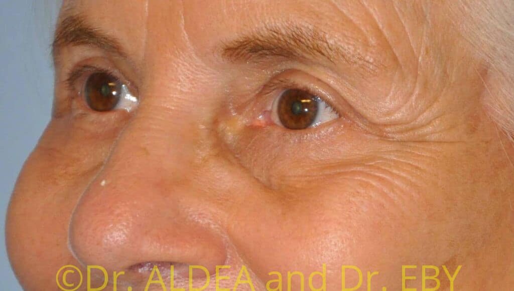 After Image: Blepharoplasty #708 - left-front-oblique