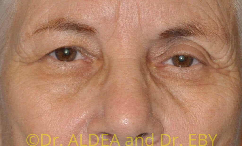 Before Image: Blepharoplasty #708 - front