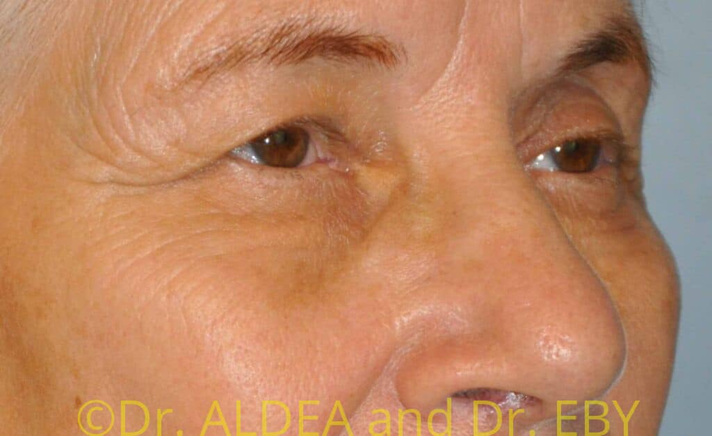 Before Image: Blepharoplasty #708 - right-front-oblique