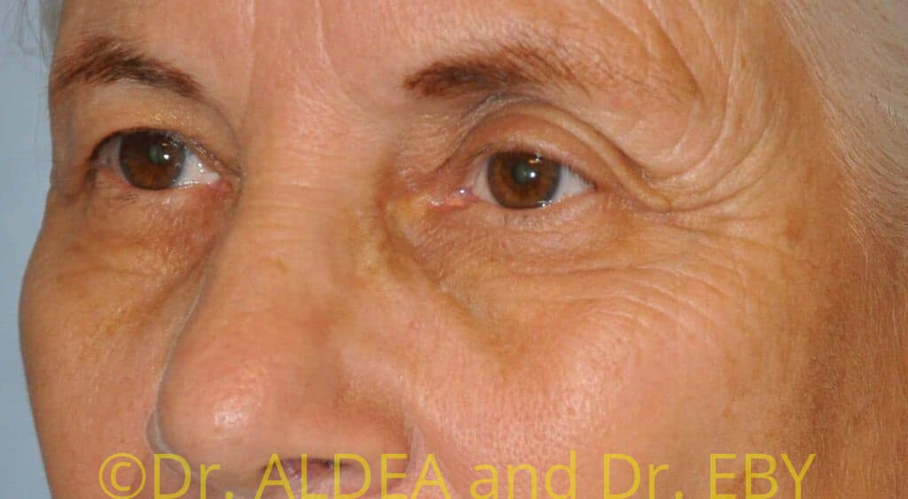 Before Image: Blepharoplasty #708 - left-front-oblique