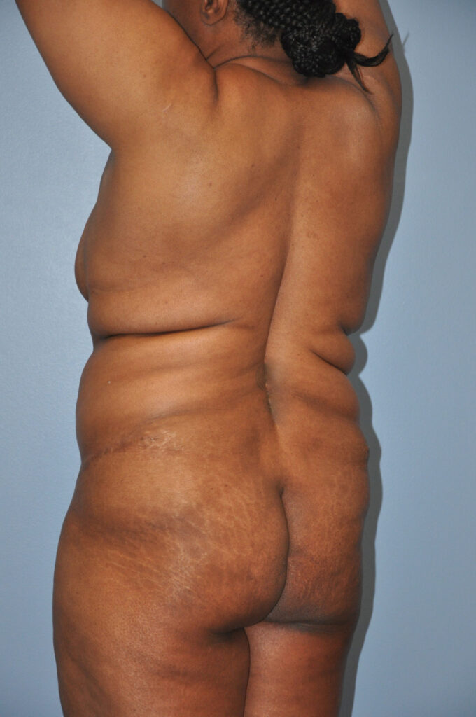 Before Image: Precision BBL #278 - left-back-oblique