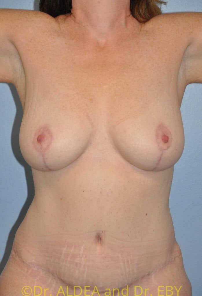 After Image: Short Scar Breast Lift (Mastopexy) #667 - front