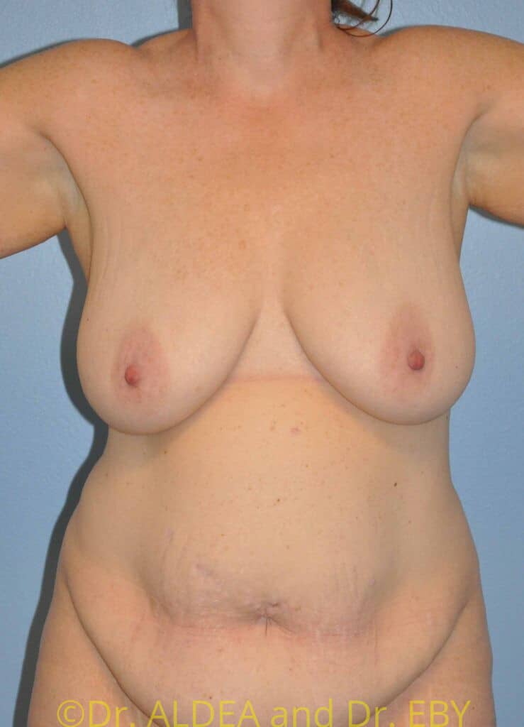 Before Image: Short Scar Breast Lift (Mastopexy) #667 - front