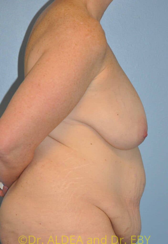Before Image: Short Scar Breast Lift (Mastopexy) #667 - right-side