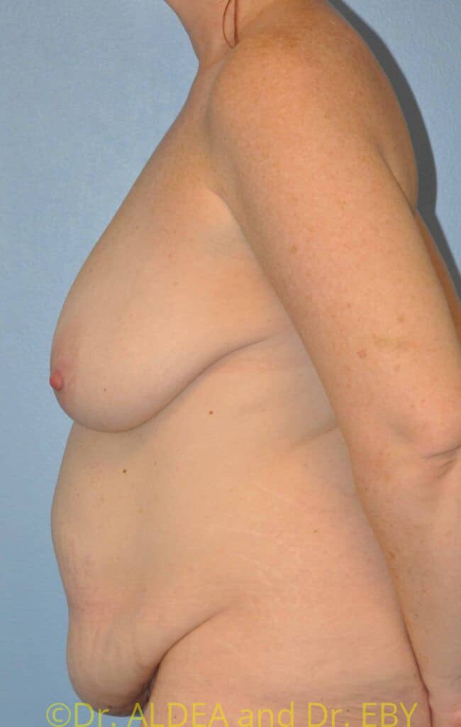 Before Image: Short Scar Breast Lift (Mastopexy) #667 - left-side