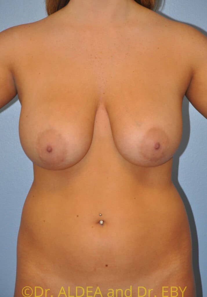 Before Image: Short Scar Breast Reduction #992 - front