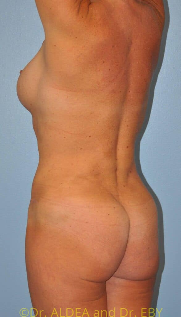 After Image: Back Scoop Liposuction #928 - left-back-oblique