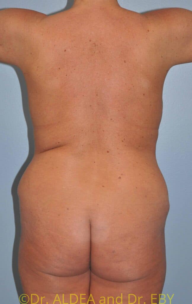 Before Image: Back Scoop Liposuction #928 - back