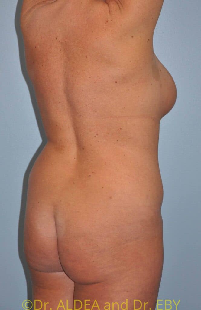 Before Image: Back Scoop Liposuction #928 - right-back-oblique
