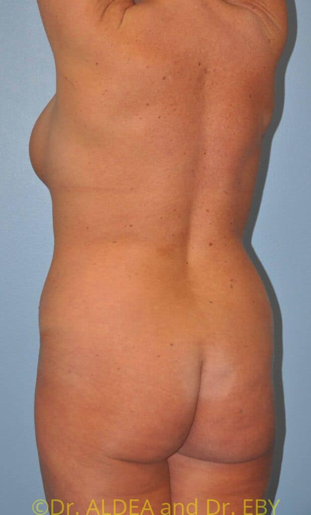 Before Image: Back Scoop Liposuction #928 - left-back-oblique