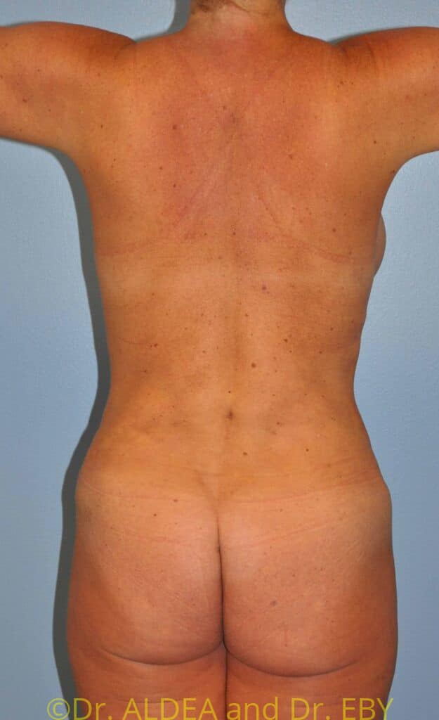 After Image: Back Scoop Liposuction #928 - back