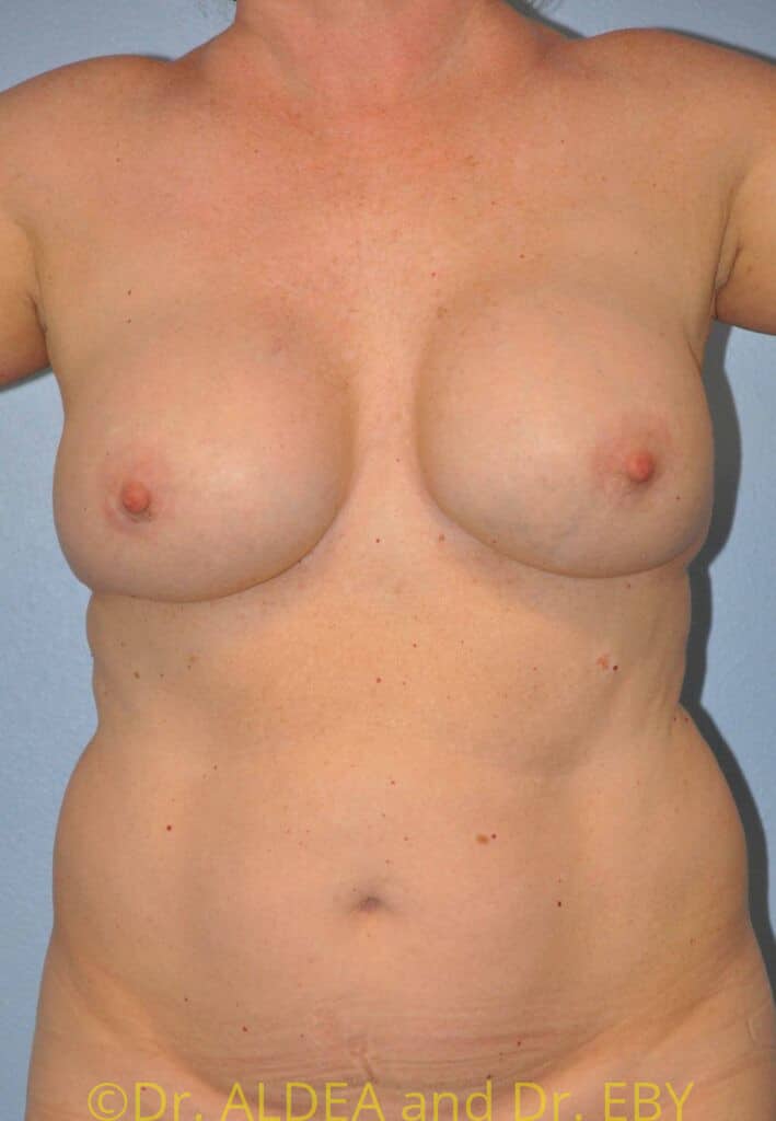 Before Image: Breast Implant Removal (Explantation) WITH a Lift #308 - front