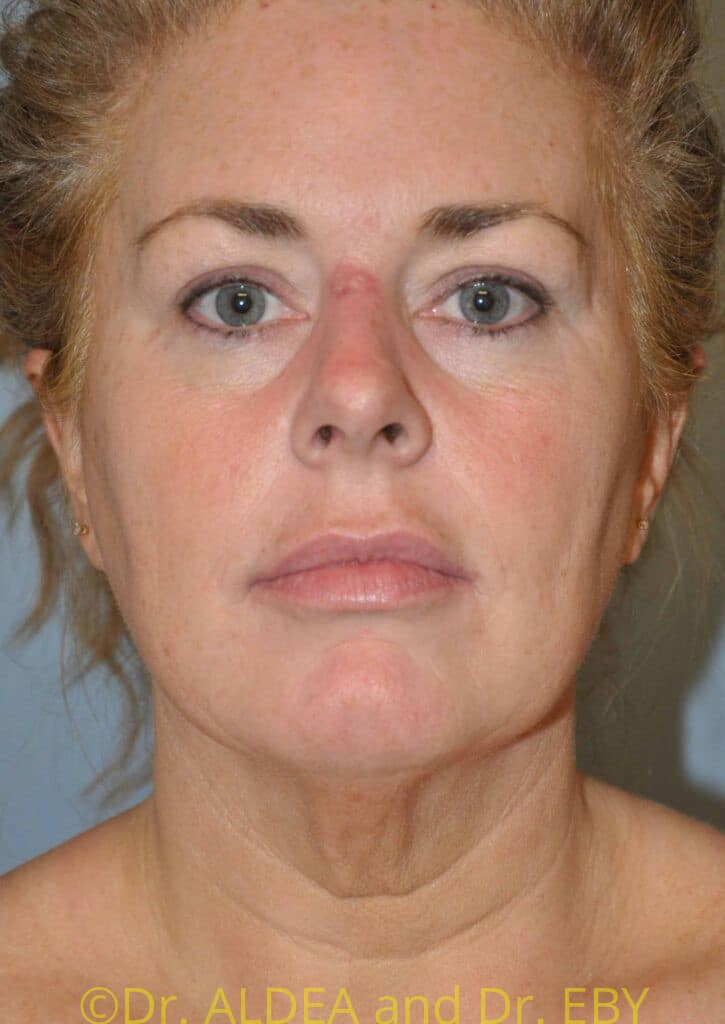Before Image: Facelift #480 - front