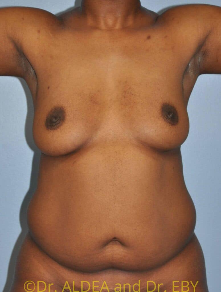 Before Image: Fat Transfer to Breasts #699 - front