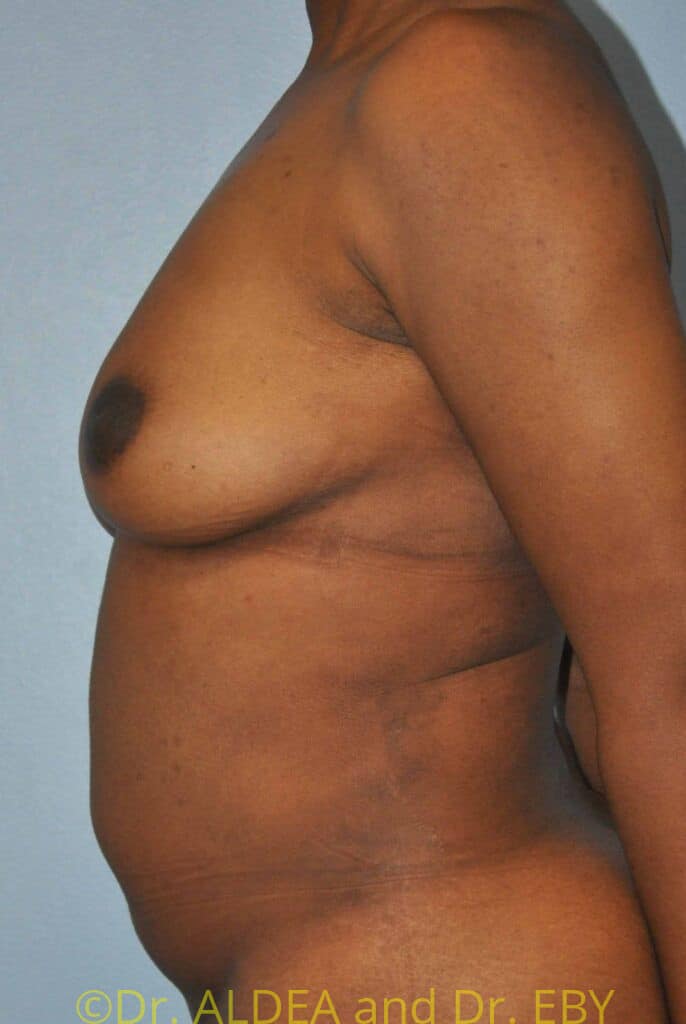 After Image: Fat Transfer to Breasts #699 - left-side