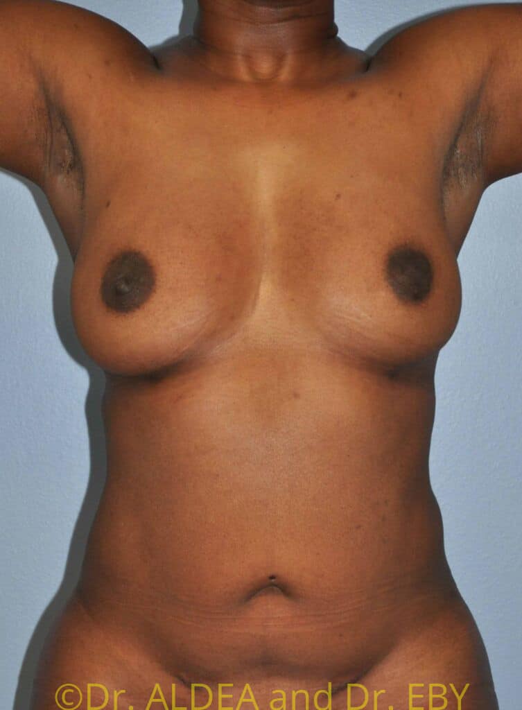 After Image: Fat Transfer to Breasts #699 - front