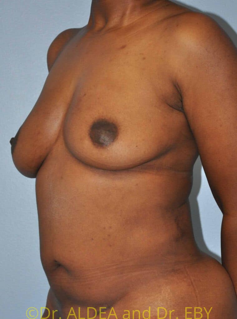 After Image: Fat Transfer to Breasts #699 - left-front-oblique