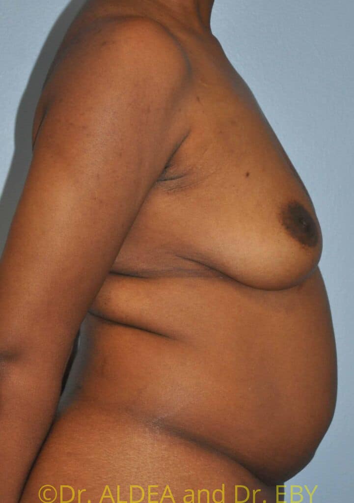 Before Image: Fat Transfer to Breasts #699 - right-side