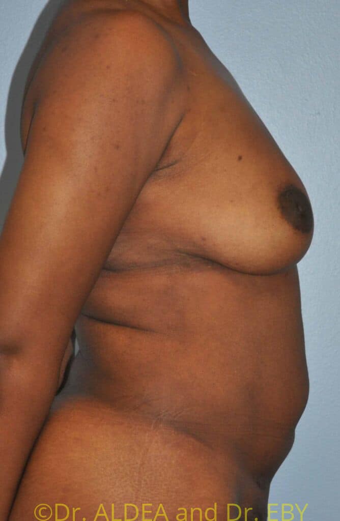 After Image: Fat Transfer to Breasts #699 - right-side