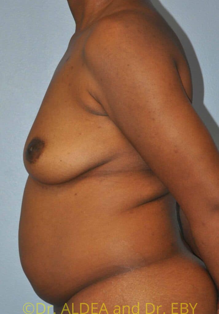 Before Image: Fat Transfer to Breasts #699 - left-side