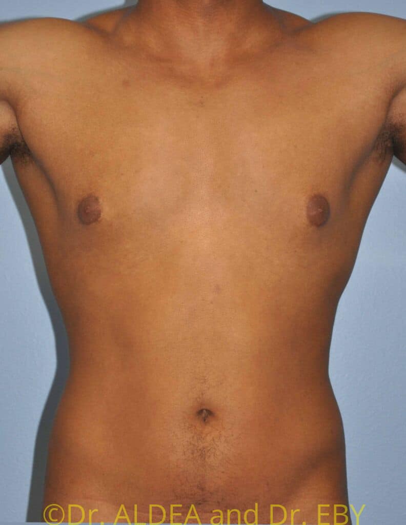 Before Image: Gynecomastia #679 - front