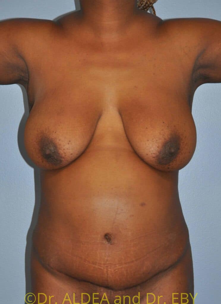 Before Image: Liposuction #875 - front
