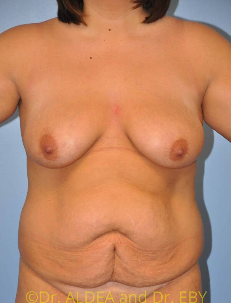 Before Image: Mommy Makeover #129 - front