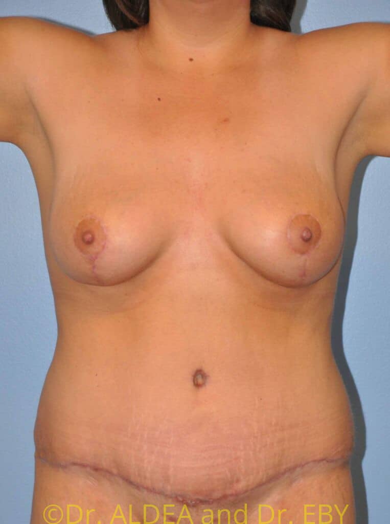 After Image: Mommy Makeover #129 - front