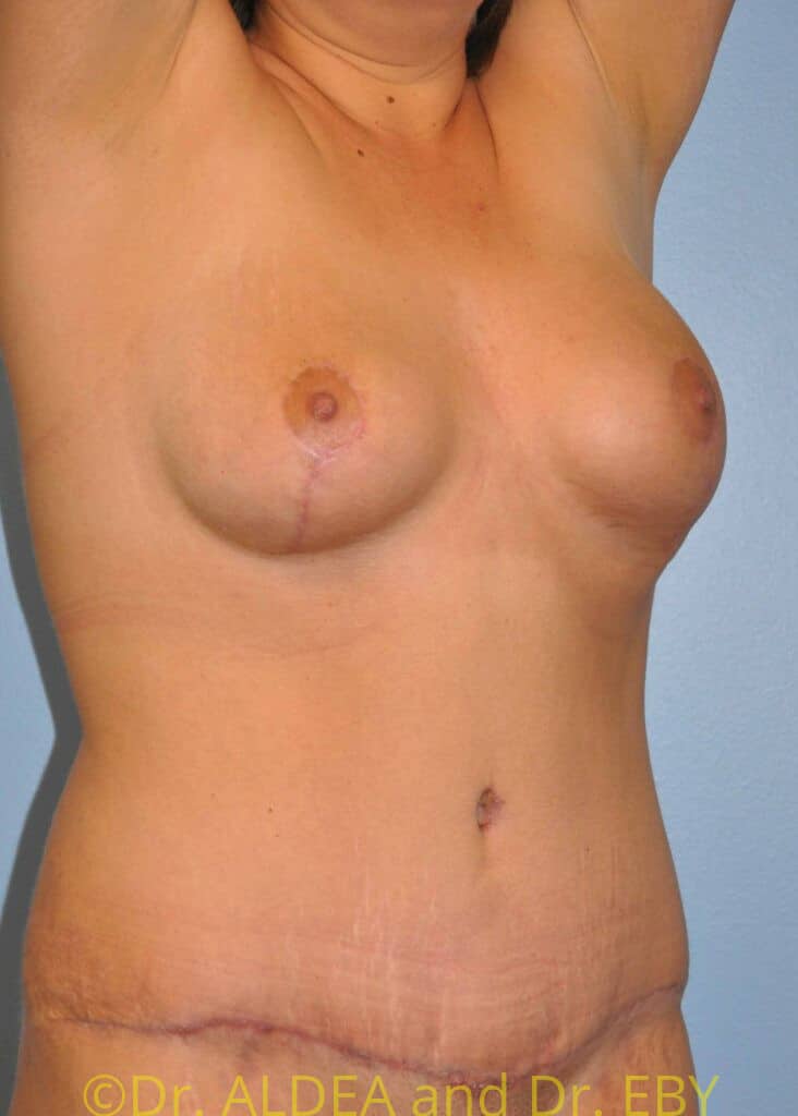 After Image: Mommy Makeover #129 - right-front-oblique