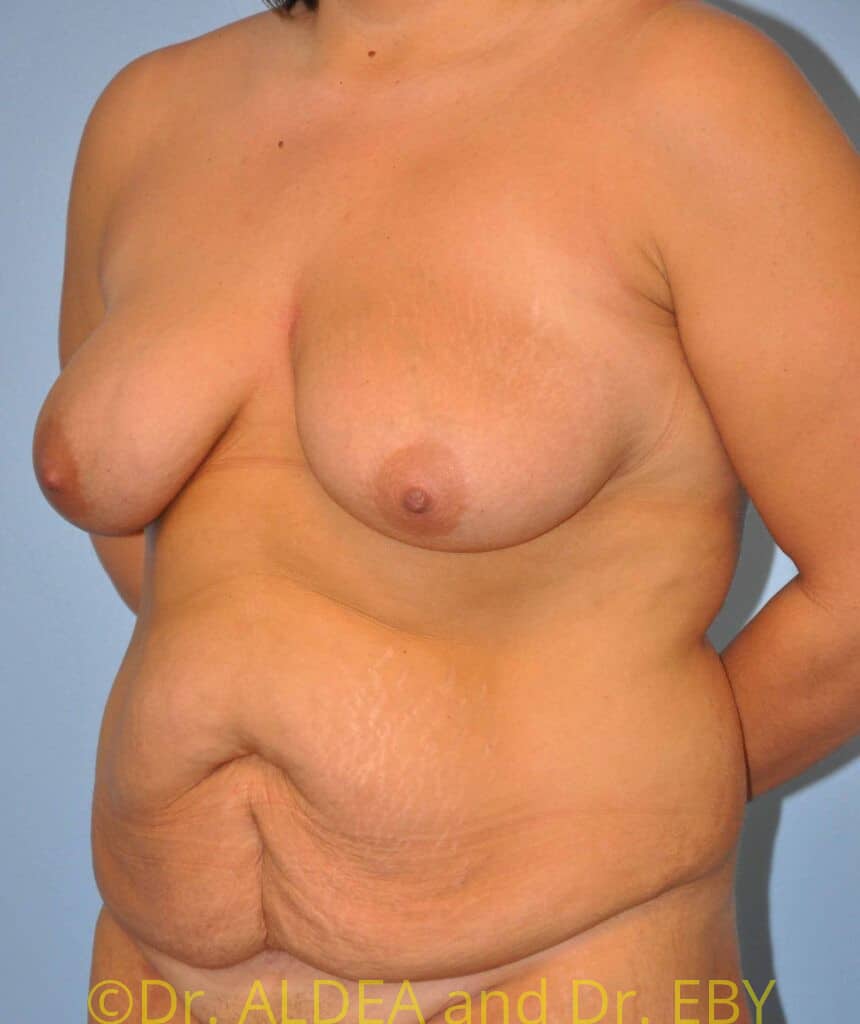 Before Image: Mommy Makeover #129 - left-front-oblique
