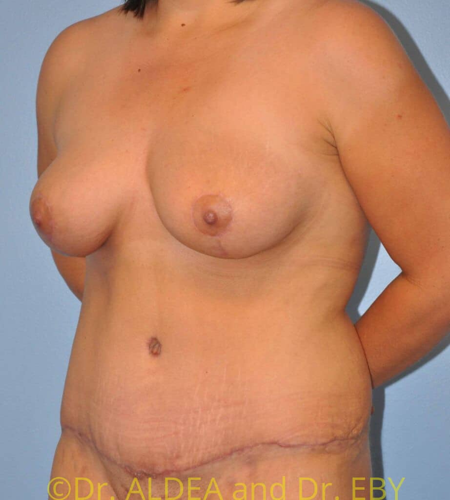 After Image: Mommy Makeover #129 - left-front-oblique