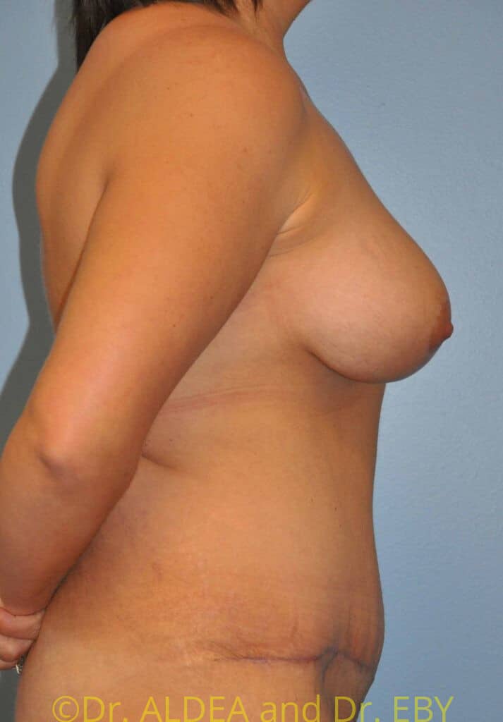 After Image: Mommy Makeover #129 - right-side