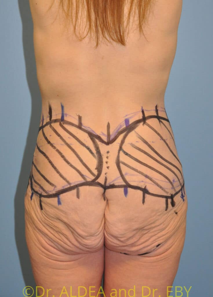 Before Image: Weight loss (MWL) Butt and Thigh Lift #860 - back
