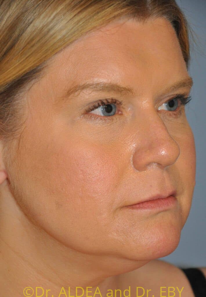 Before Image: Neck Liposuction #583 - right-front-oblique