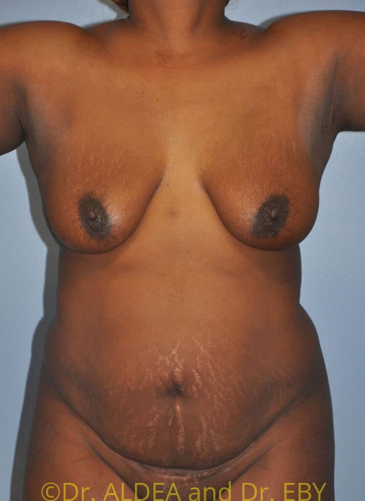 Before Image: Tummy Tuck #862 - front