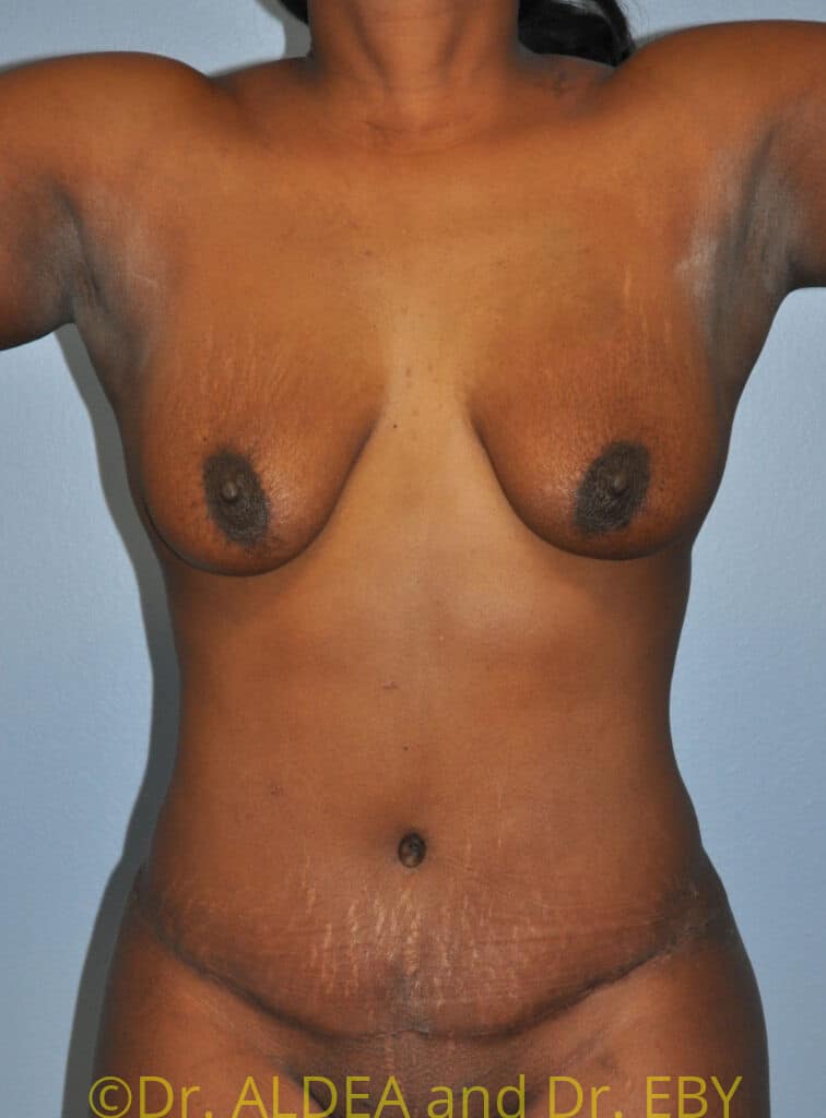 After Image: Tummy Tuck #862 - front