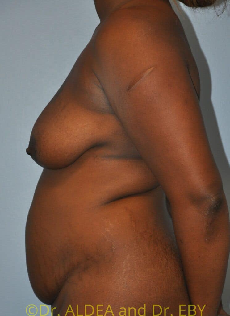 Before Image: Tummy Tuck #862 - left-side