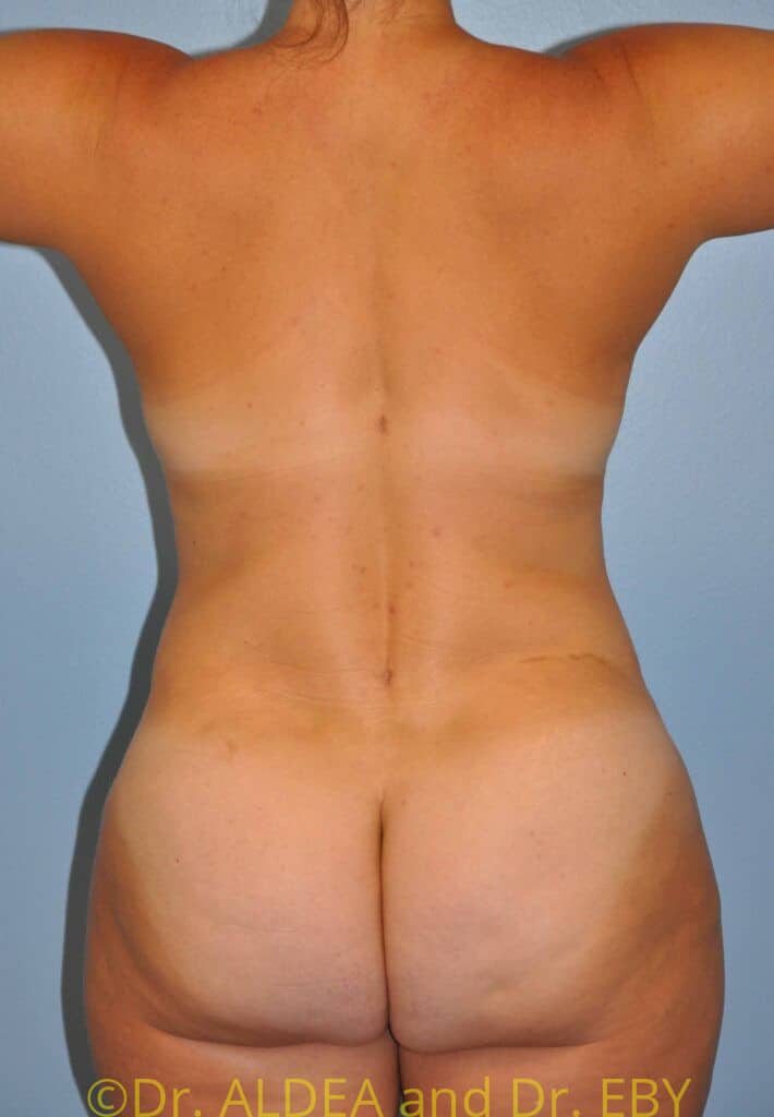 After Image: Back Scoop Liposuction #842 - back