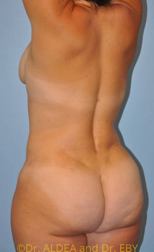 After Image: Back Scoop Liposuction #842 - left-back-oblique