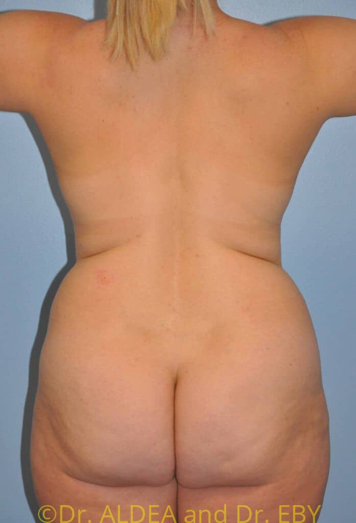 Before Image: Back Scoop Liposuction #842 - back