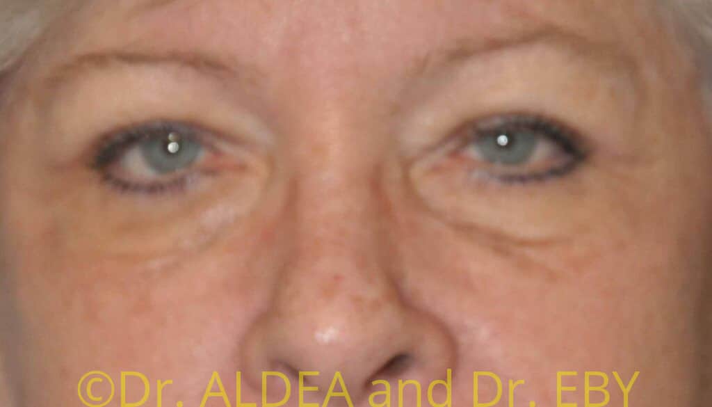 After Image: Blepharoplasty #419 - front